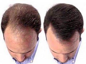 Alopecia y FCP Alopecia y FCP