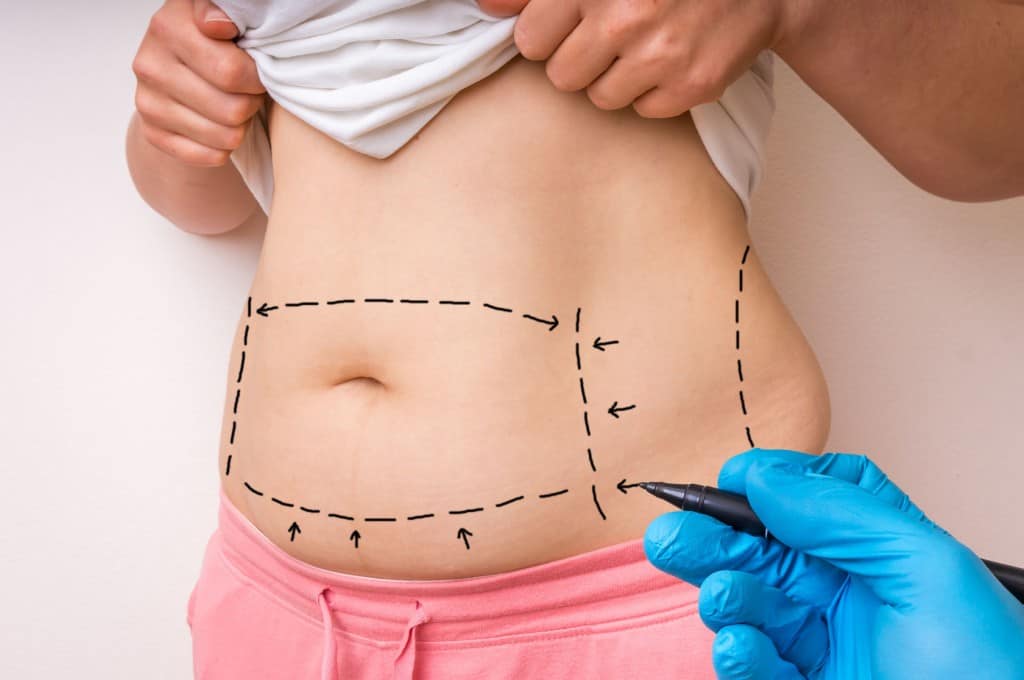 Abdominoplastia-1024x680-1