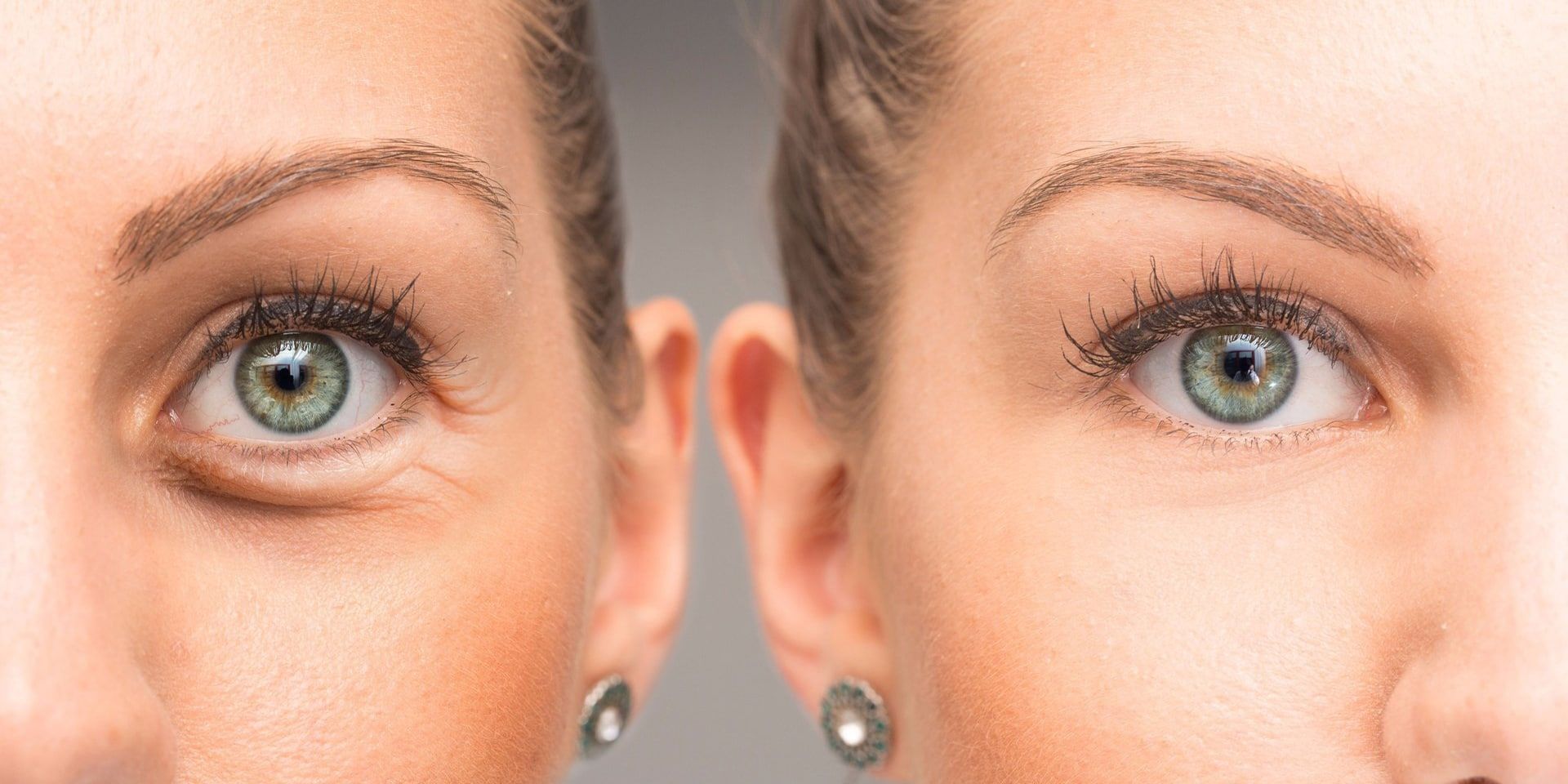 Dark-circles-eye-reduction-auckland