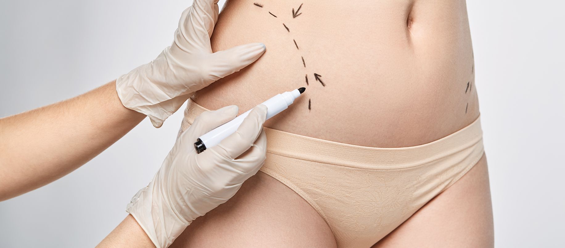 Mesoterapia-abdomen
