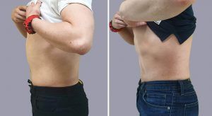 antes-despues-lado-hombre