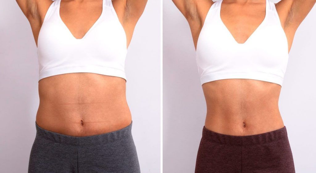 antes-despues-mujer
