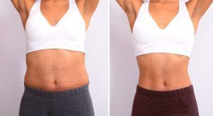 antes-despues-mujer