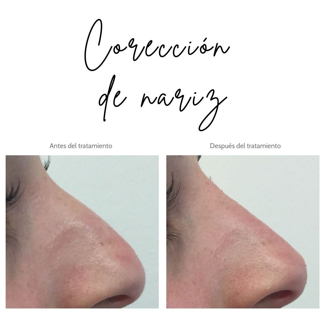 corrección-nariz