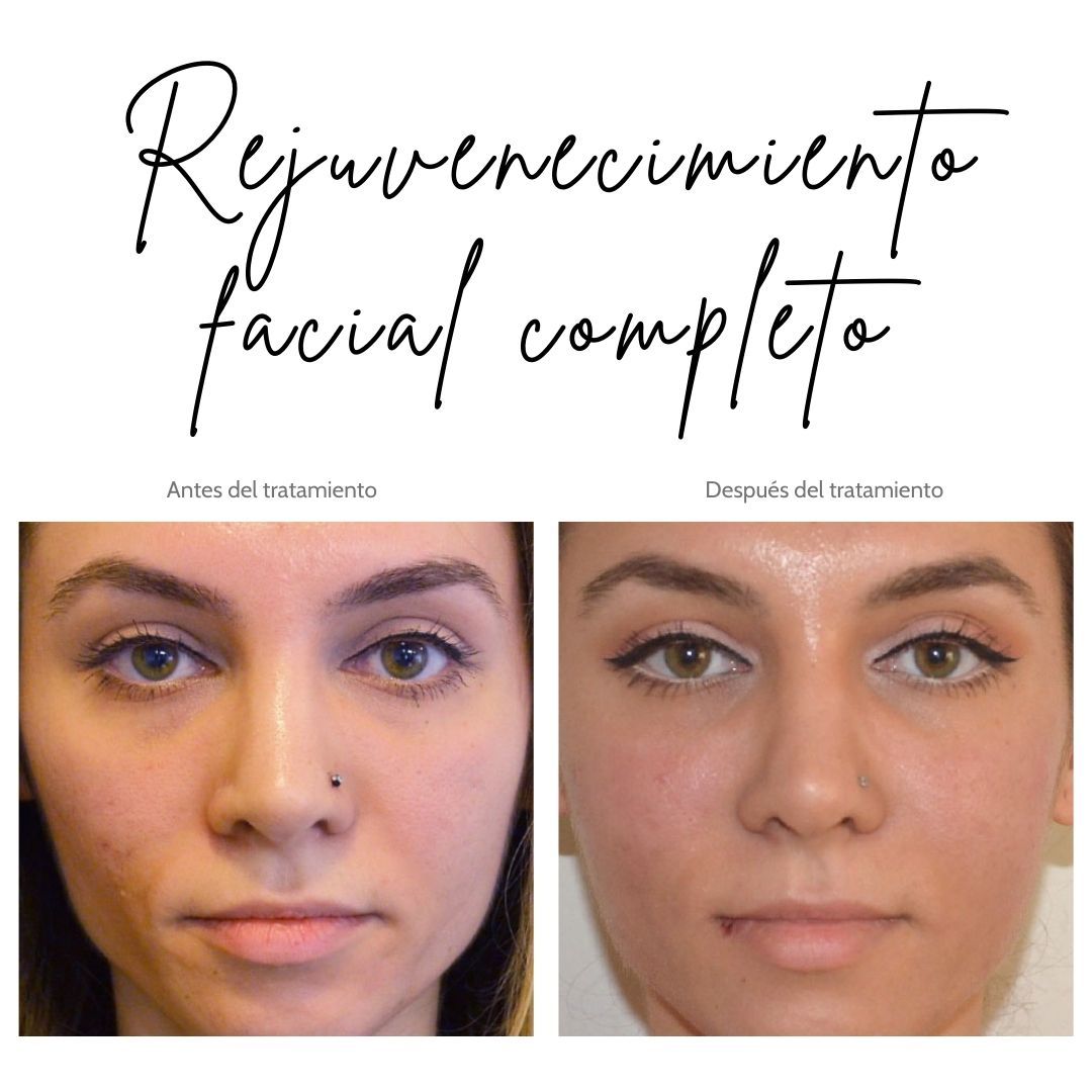 rejuvenecimiento-facial
